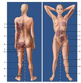 Aree del corpo interessate dalla Liposuzione